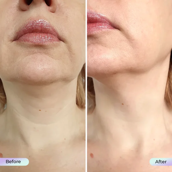 Aduro Light Therapy Neck Mask